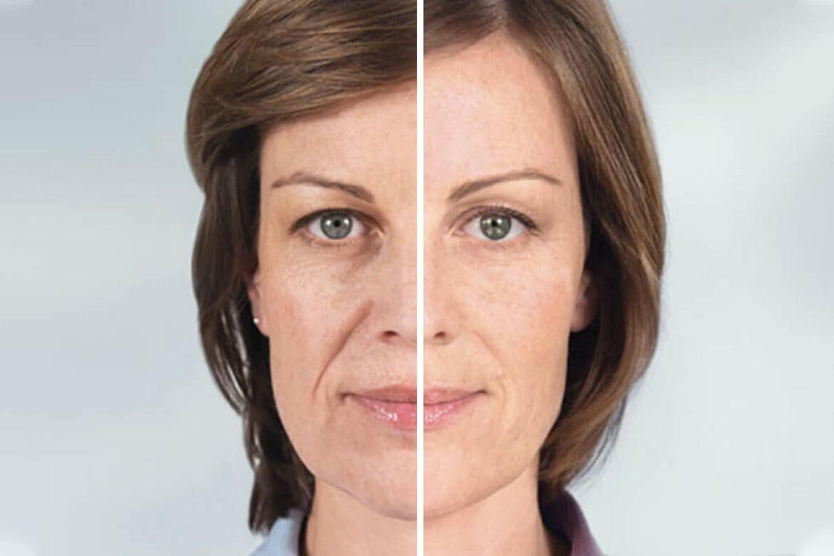 Liquid Face lift with Sculptra