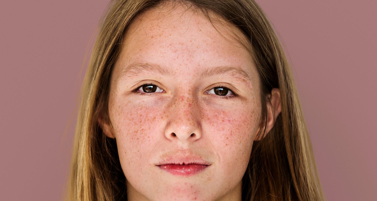 Rawatan Jeragat Muka Sesuai Untuk Kulit Asia | Enhanze Clinic