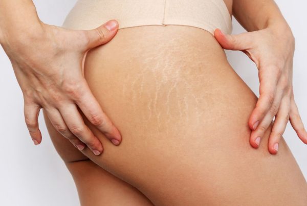 cara hilangkan stretch mark​