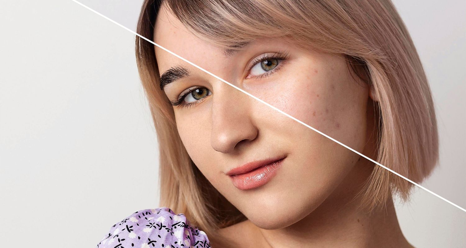 Jeragat Muka: Apa Yang Memburukkan Keadaan Kulit