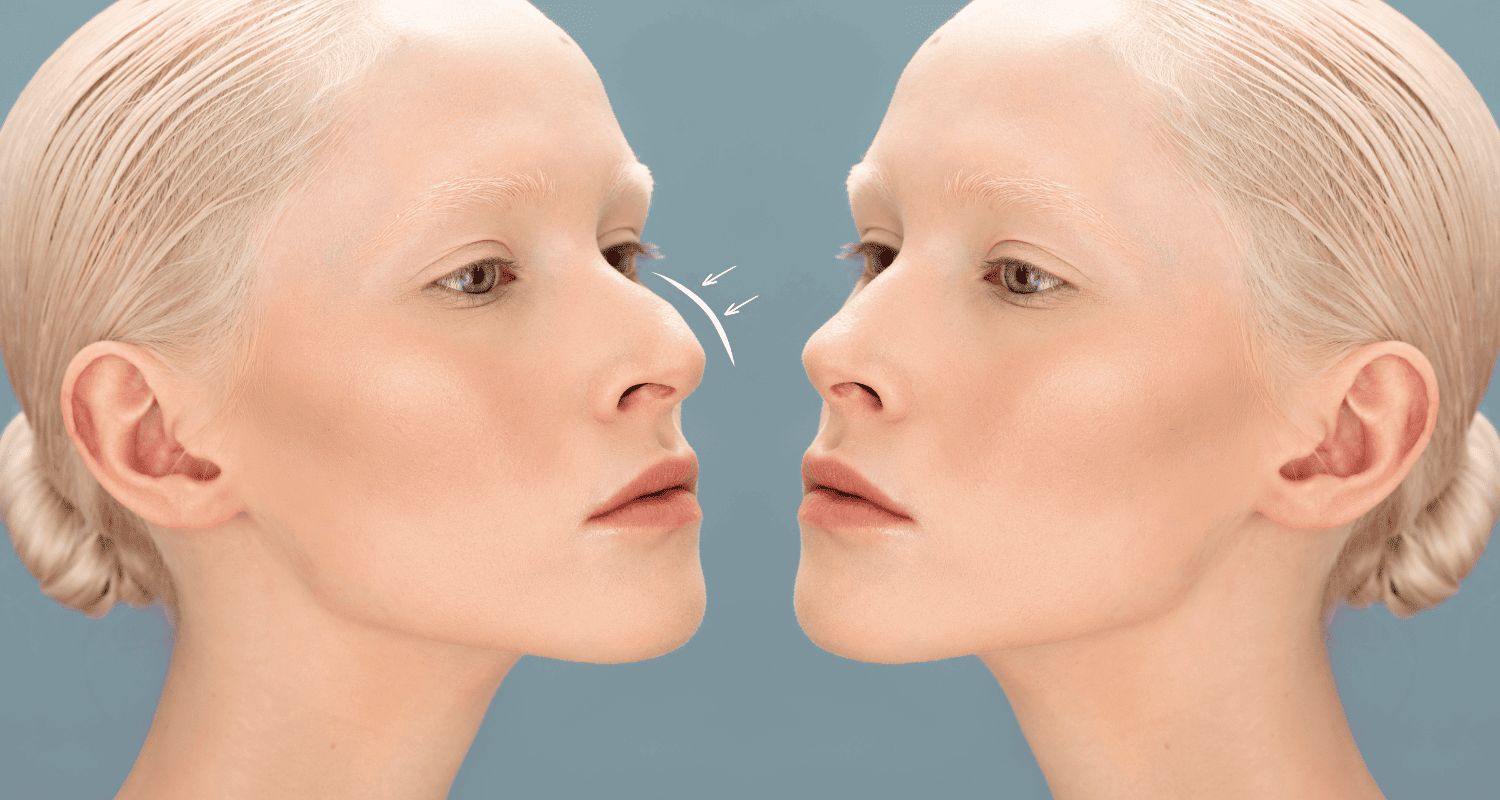 Can Nose Thread Lift Correct a Crooked Nose? | Enhanze Clinic