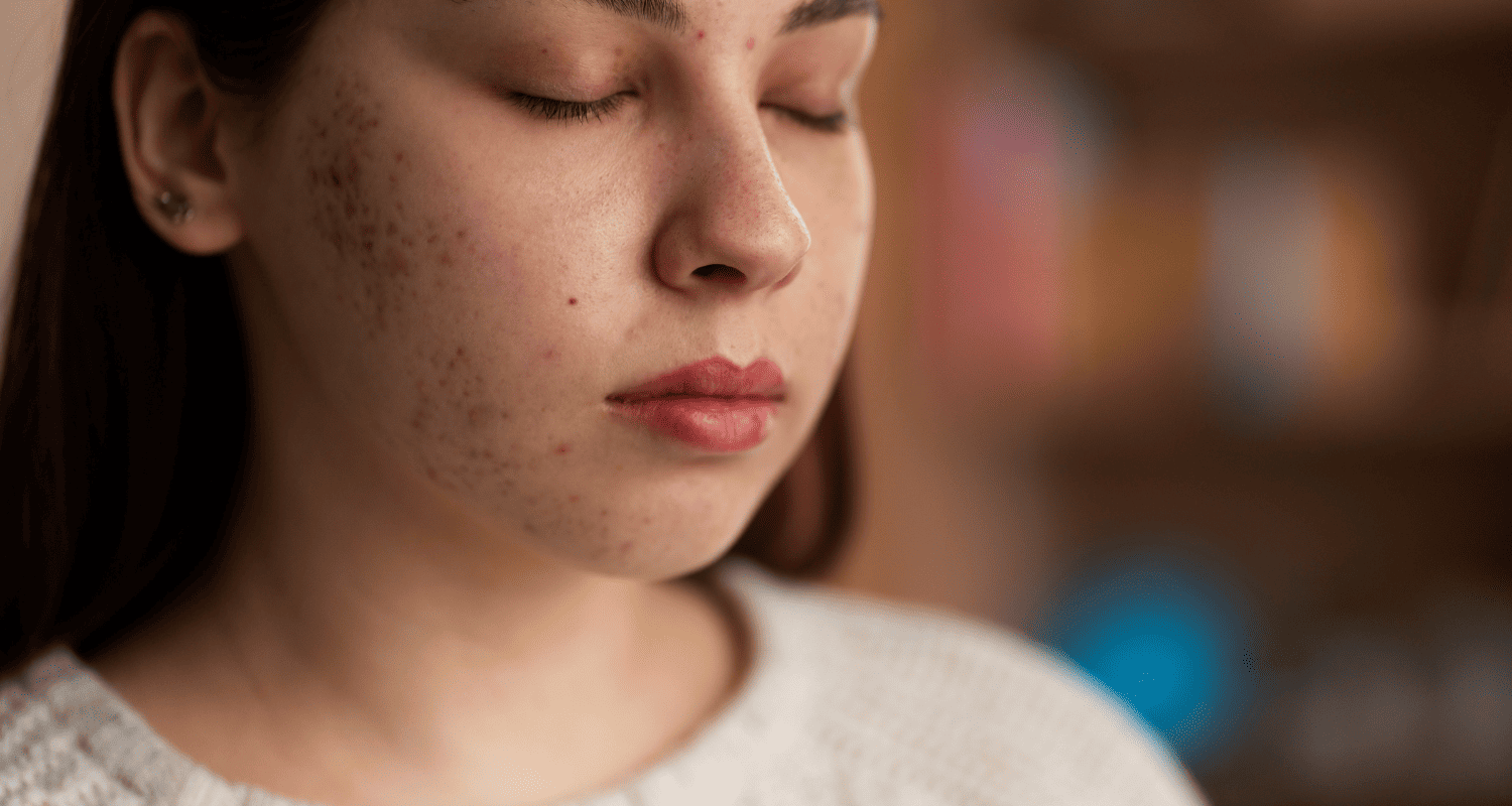 Masalah Kulit: Perbezaan Antara Jerawat dan Alahan | Enhanze Clinic