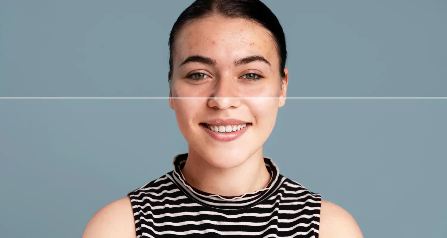 Jeragat Muka: Perbezaan Antara Jeragat dan Melasma