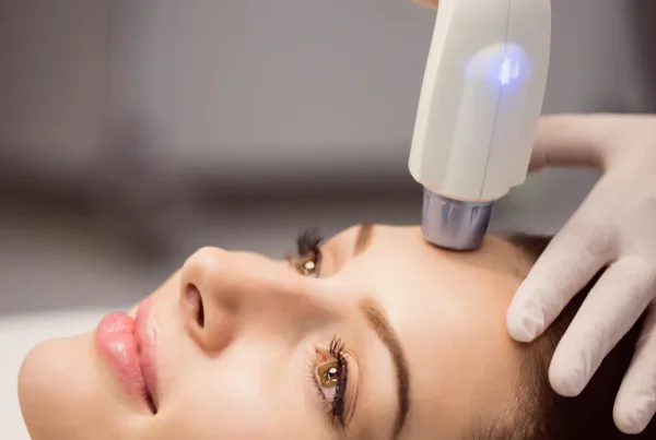 laser for pigmentation